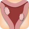 Infertility - Fibroids