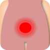 Infertility - PID