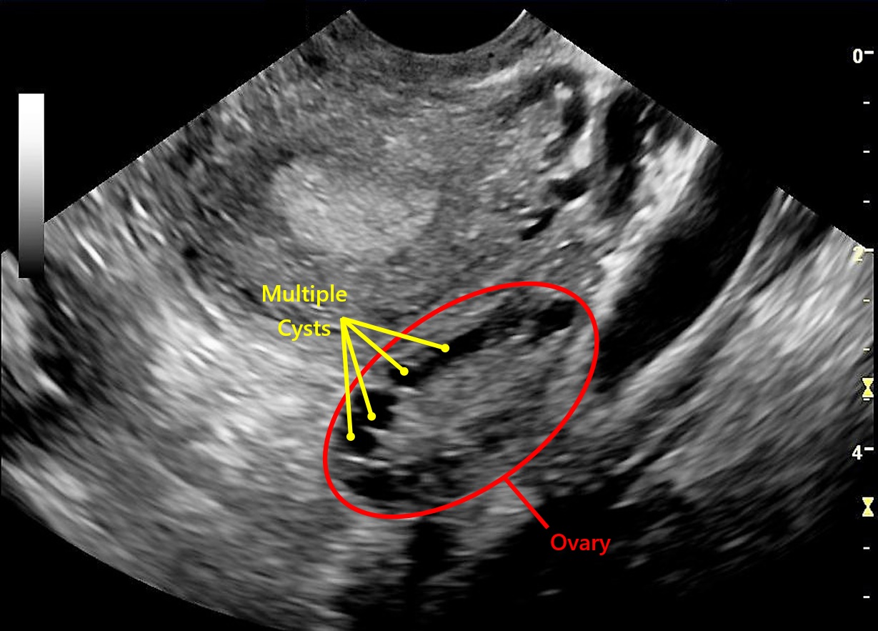 The Pelvic Scan Fertility Test | Conception