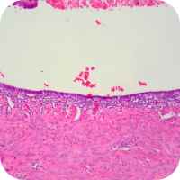 Endometriosis of the Fallopian Tube (Luminal Pattern)