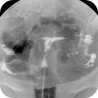 Hysterosalpingogram (HSG Test) Image