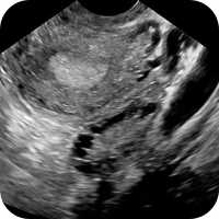 Ultrasound Scan of Ovary as part of IVF Treatment